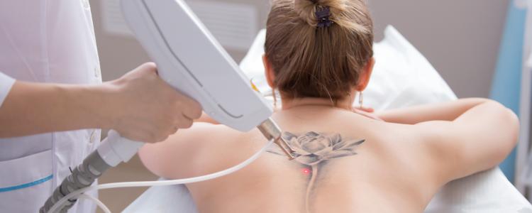 main of Get Your Questions and Concerns About Tattoo Removal Answered